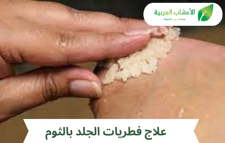علاج فطريات الجلد بالثوم